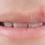 El herpes labial como una señal espiritual de desequilibrio emocional.